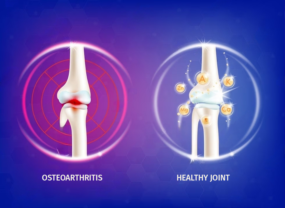 Causes of Osteoarthritis